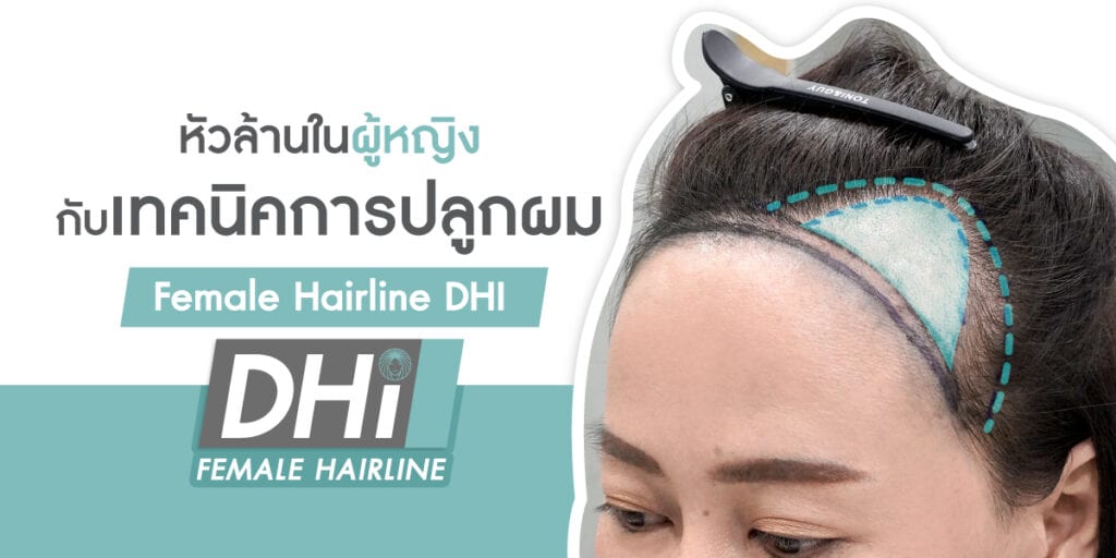 Female Hairline DHI cover