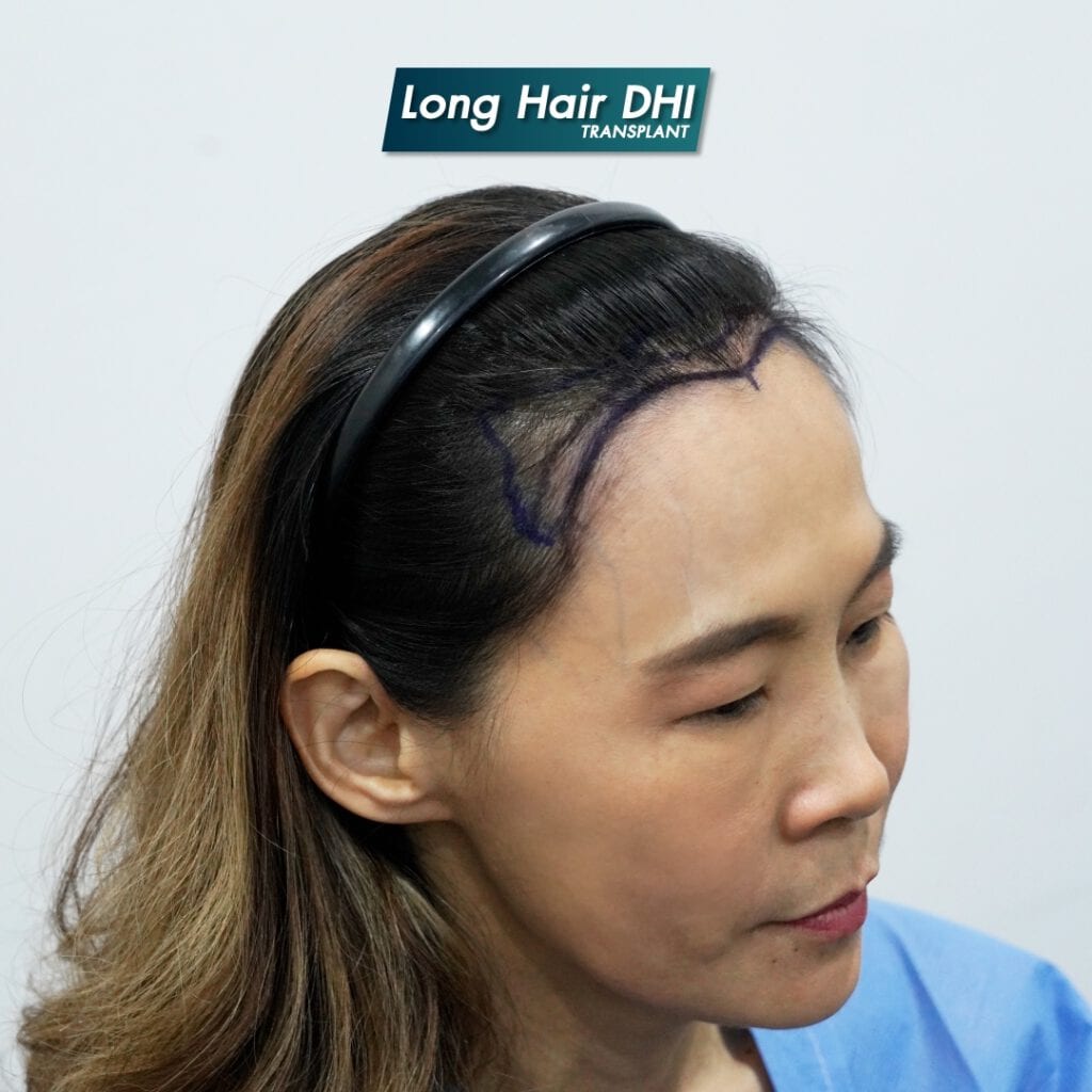 FUE 植发 | Hair Transplant and Aesthetic Clinic in Singapore | Freia Medical