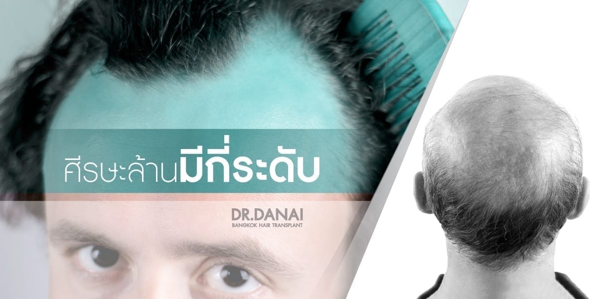 ศีรษะล้าน มีกี่ระดับ แล้วควรปลูกผมตอนไหน - Beq Clinic