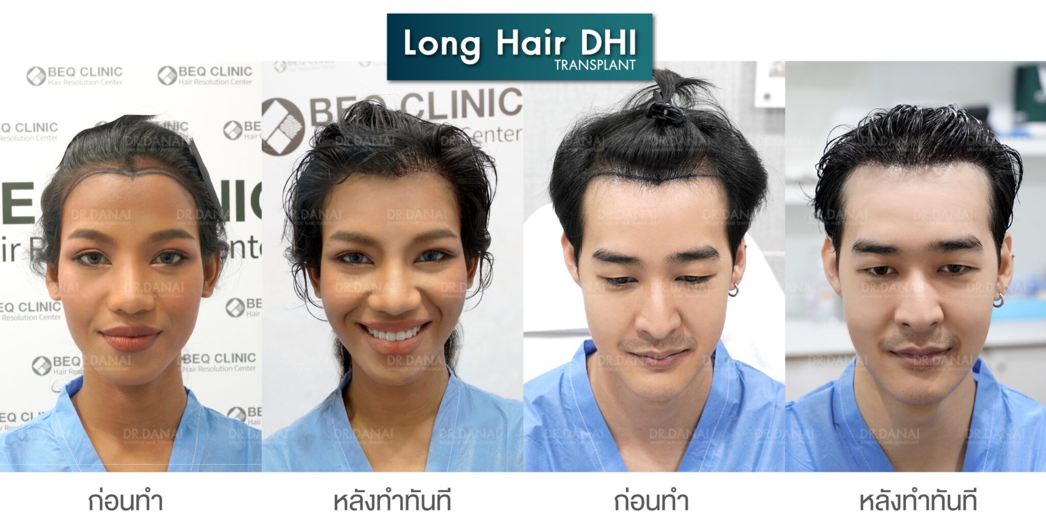 before and after Long Hair DHI