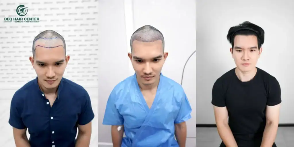 ปลูกผมผู้ชาย