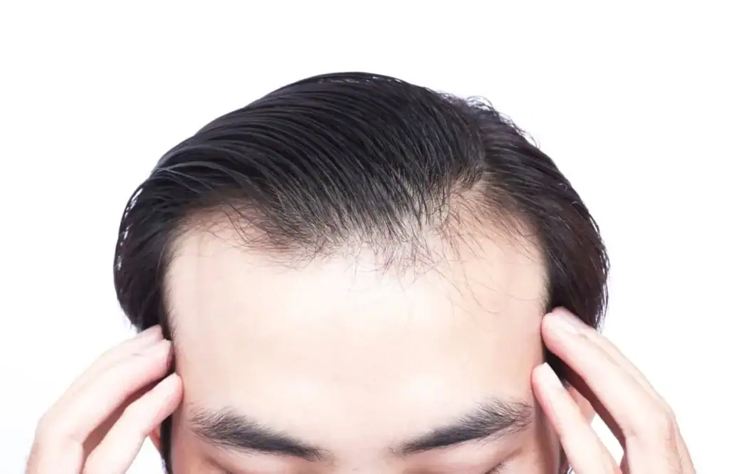 หน้าผากกว้าง