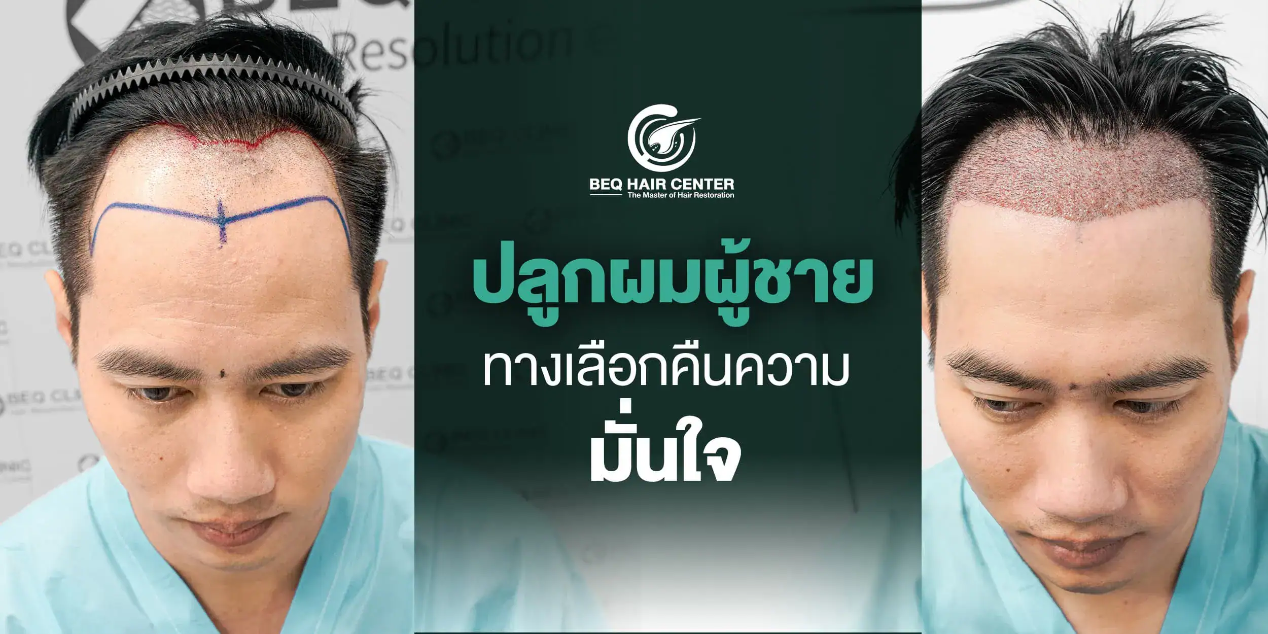 ปลูกผมผู้ชาย