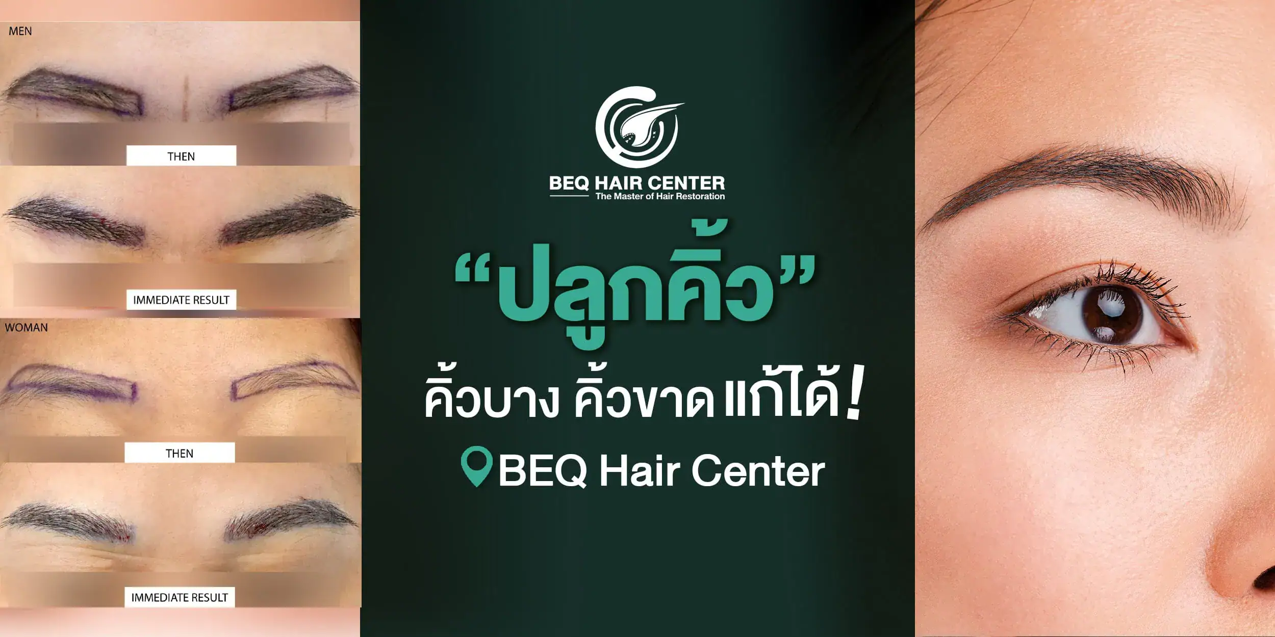 ปลูกคิ้ว