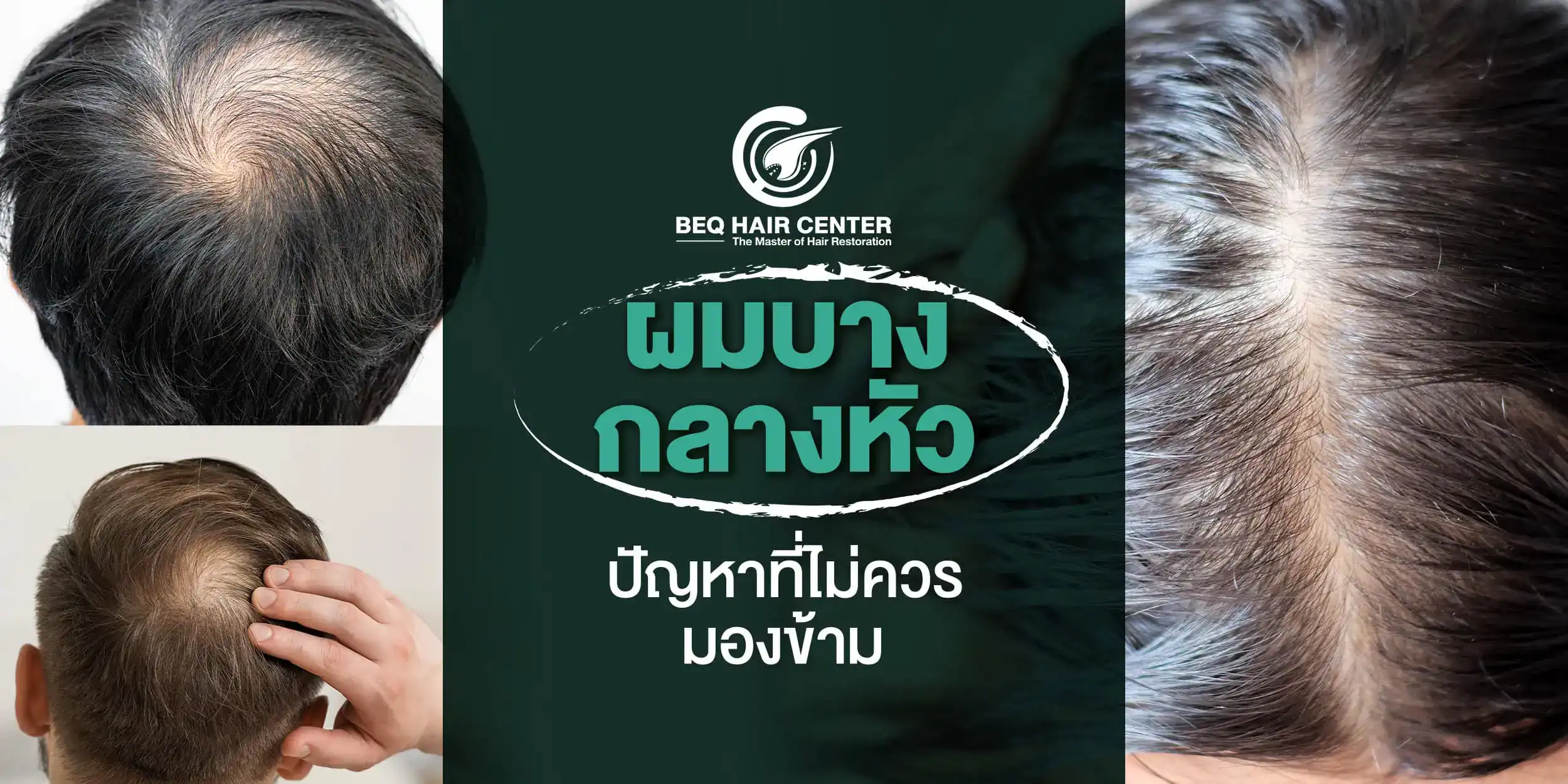 ผมบางกลางหัว
