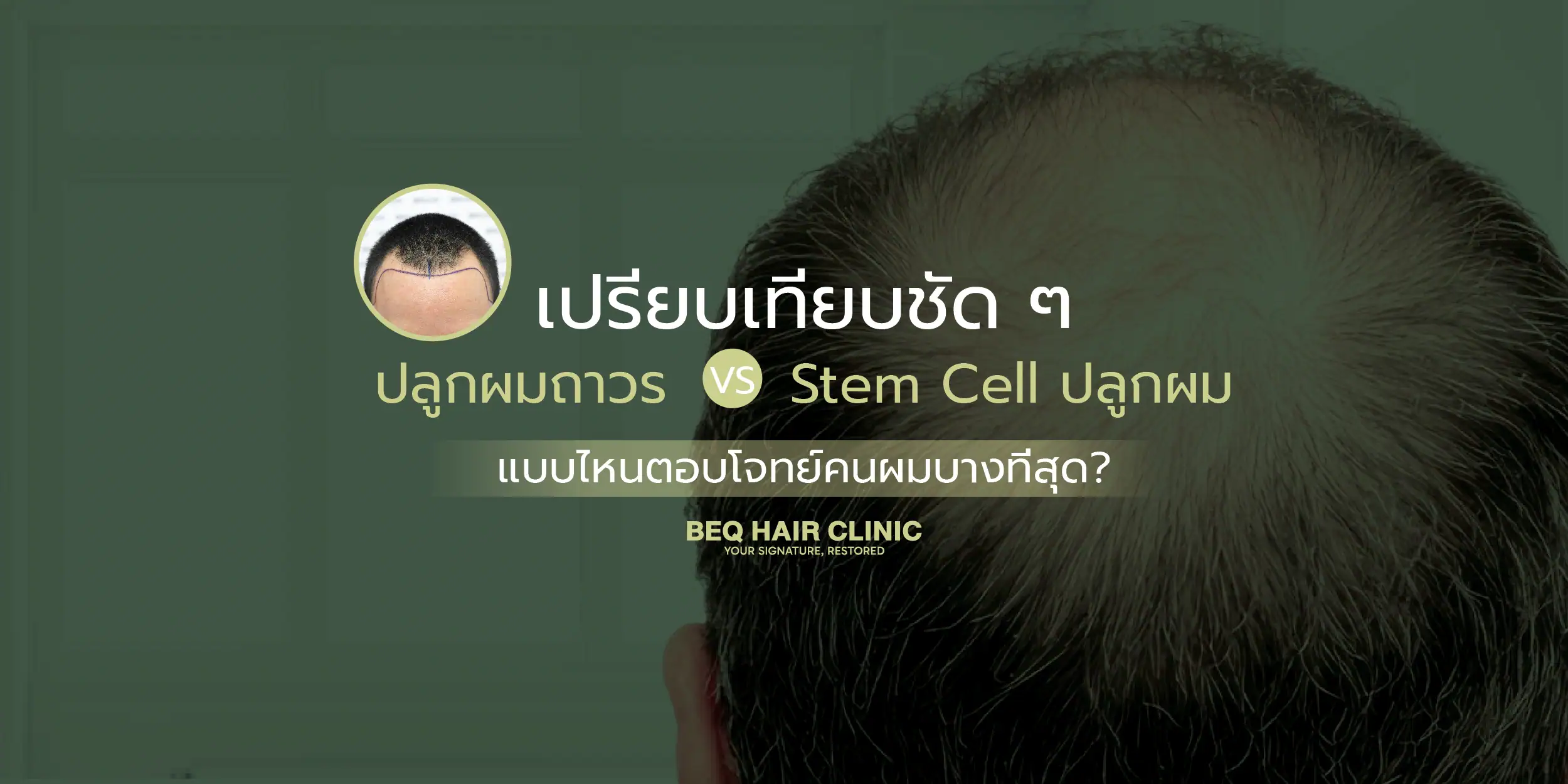 hair transplant vs stem cell thinning hair