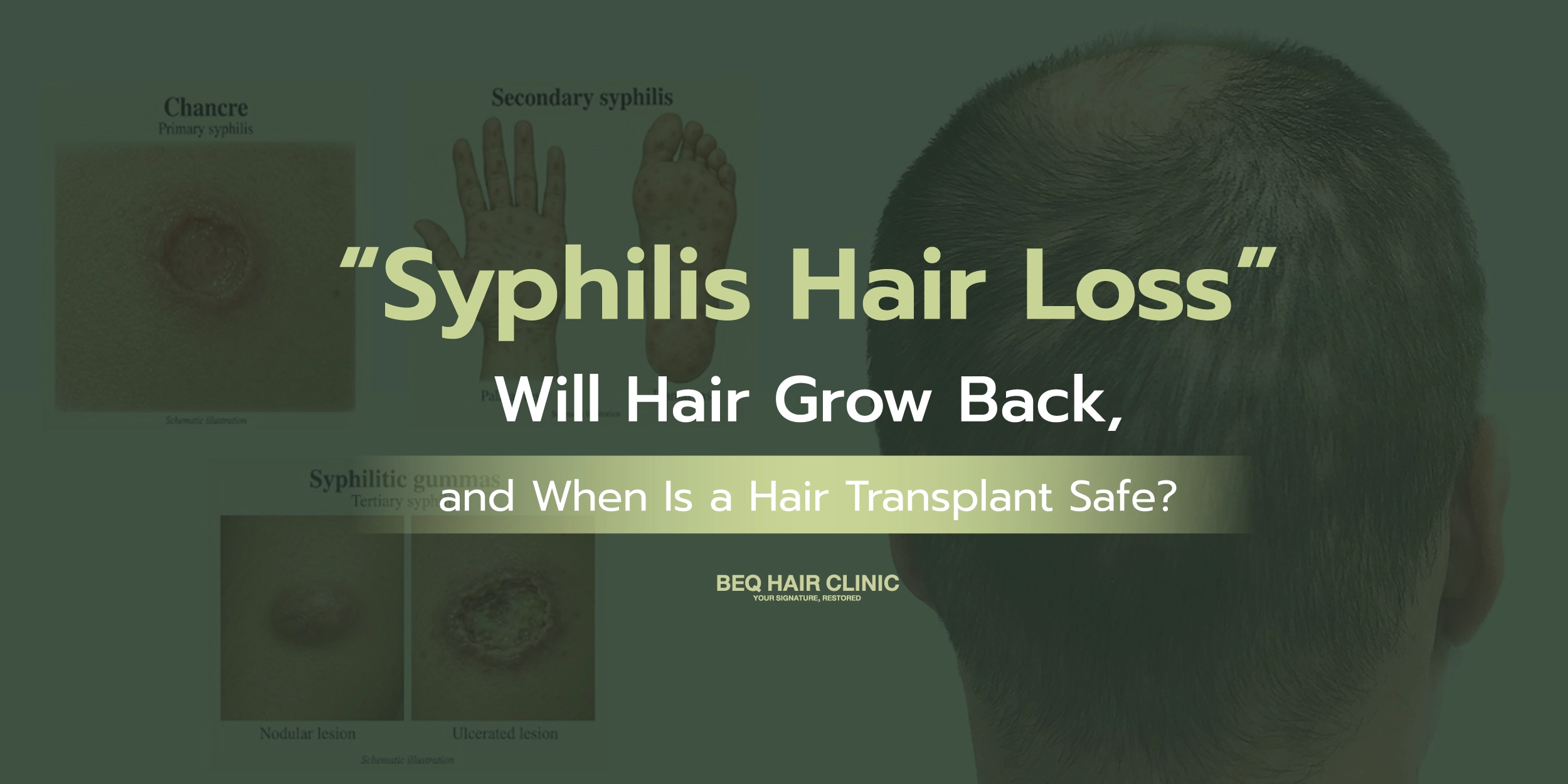 Can Syphilis Cause Hair Loss? Will Hair Grow Back After Treatment, and Is DHIv Hair Transplantation an Option?