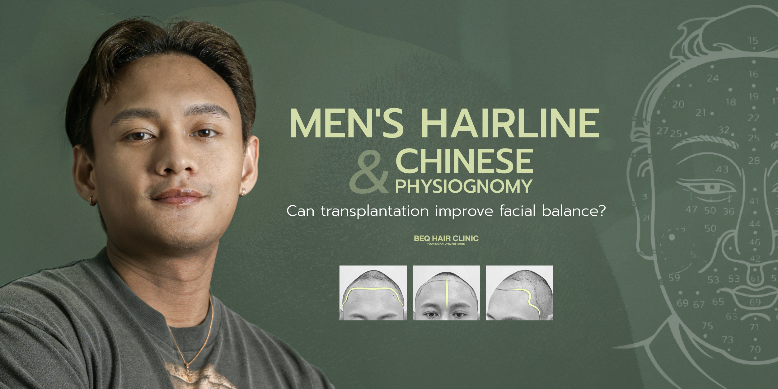Can Hair Transplantation Improve Men’s Chinese Physiognomy?
