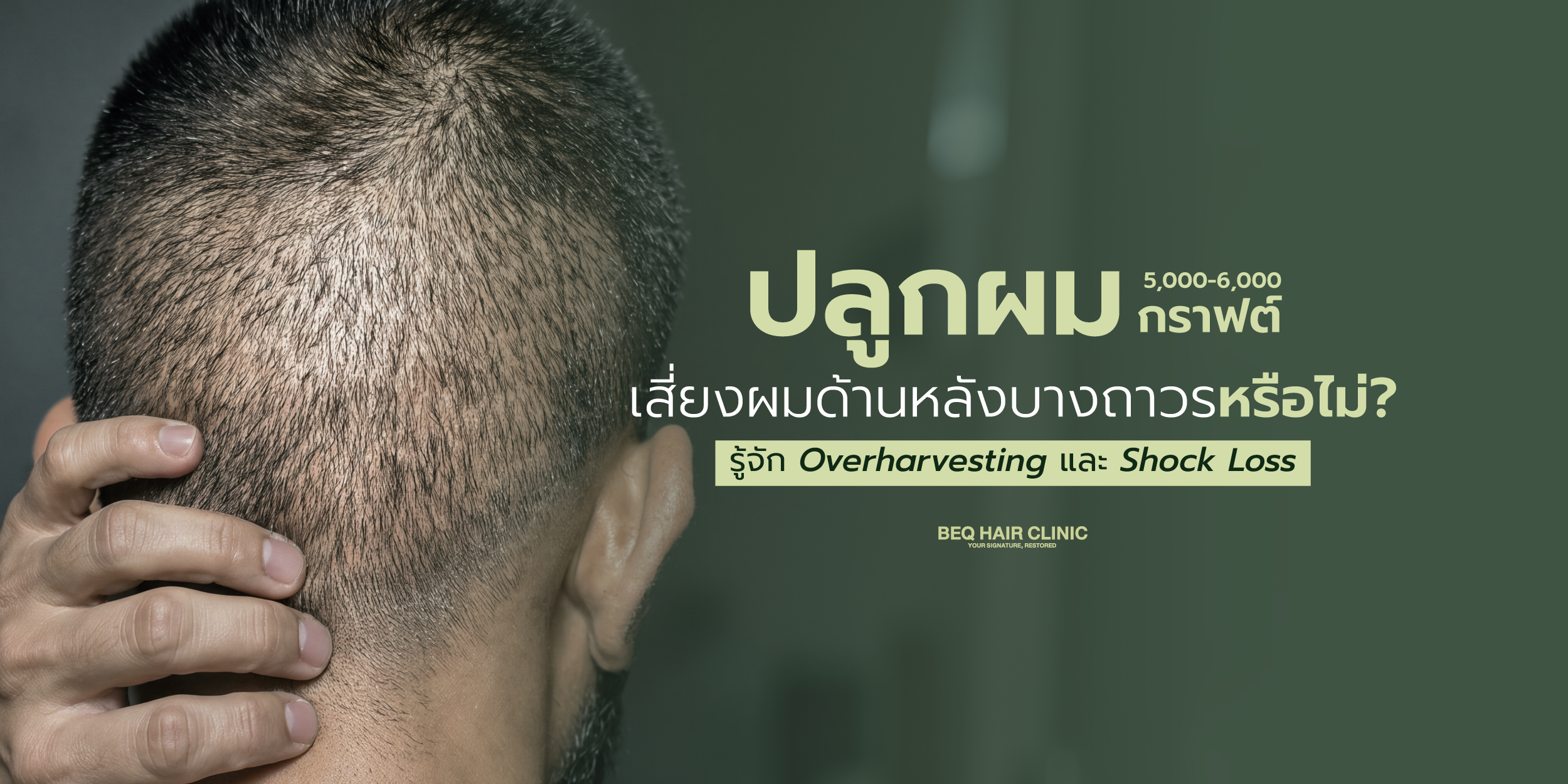 ปลูกผม 5,000–6,000 กราฟต์ เสี่ยงผมด้านหลังบางถาวรหรือไม่? รู้จัก Overharvesting และ Shock Loss