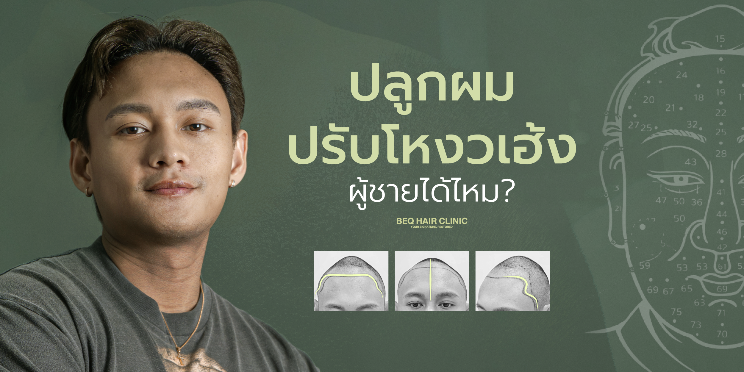 ปลูกผมปรับโหงวเฮ้งผู้ชายได้ไหม? หลักออกแบบแนวผม M-Shape หน้าผากและขมับให้เป็นธรรมชาติ