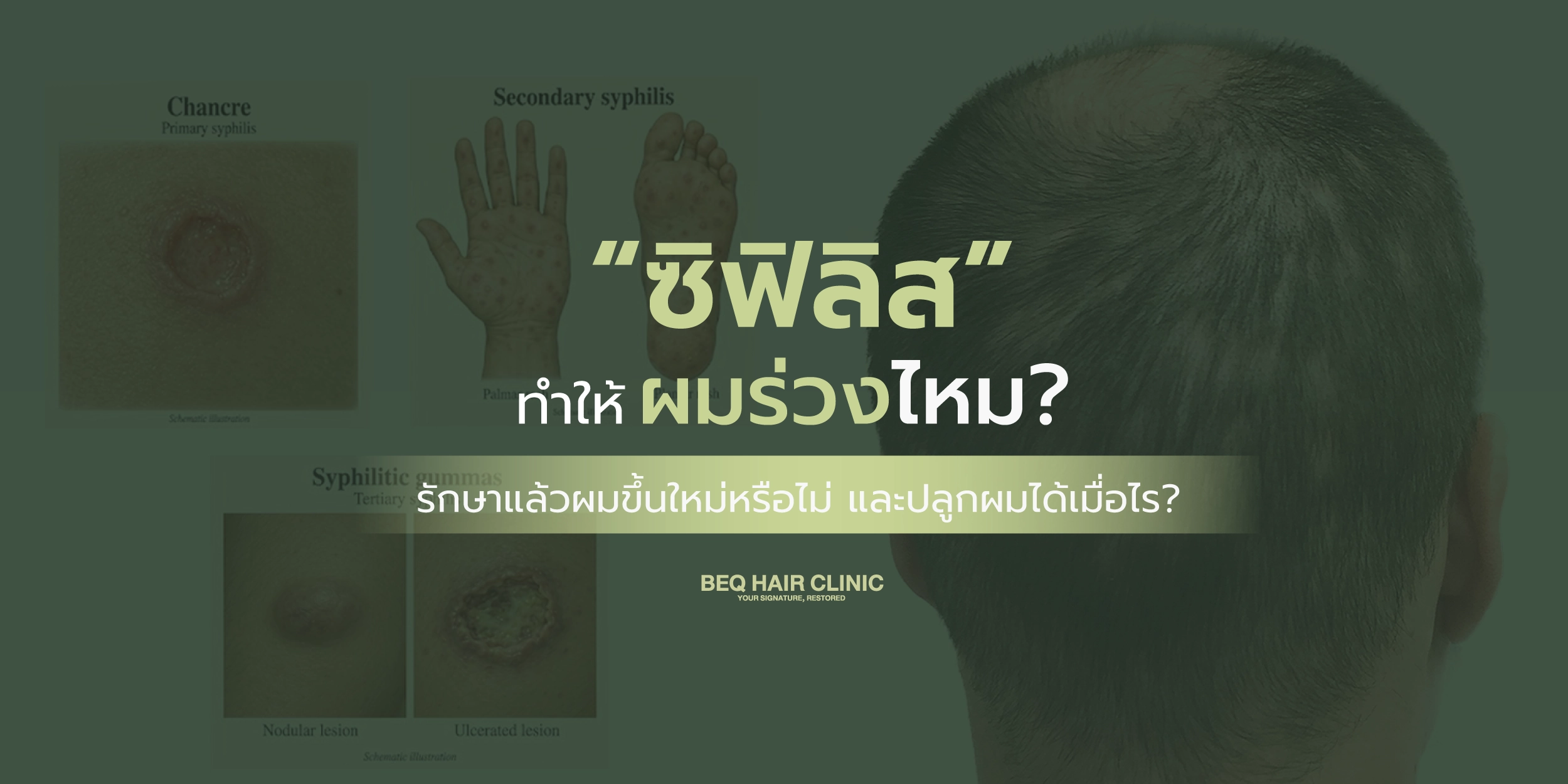 ซิฟิลิสทำให้ผมร่วงไหม? รักษาแล้วผมขึ้นใหม่หรือไม่ และปลูกผมด้วยเทคนิค DHIv ได้ไหม?